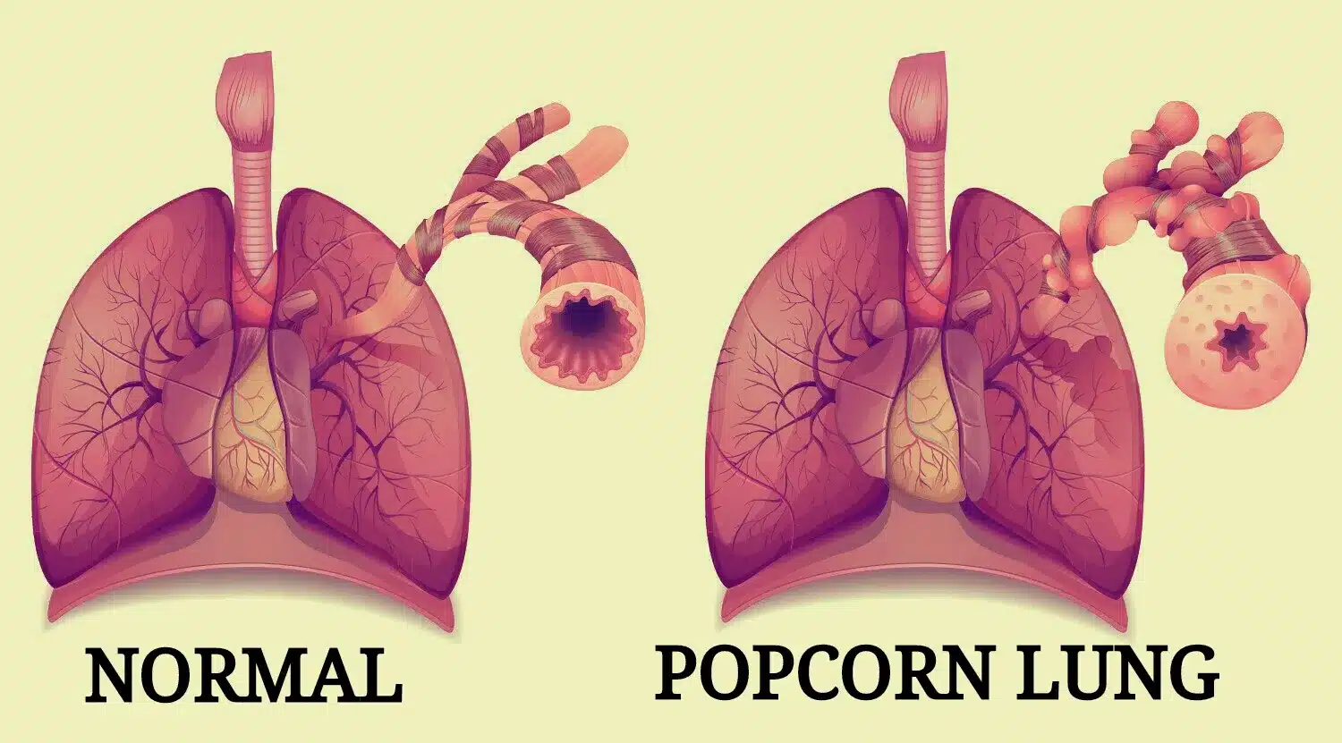 e-papieros, popcornowe płuca, mit obalony, debunkowanie, prawda o vapingu, zdrowe płuca, vape bezpieczeństwo - Czy wdychanie liquidu THC powoduje efekt „popcornowego płuca